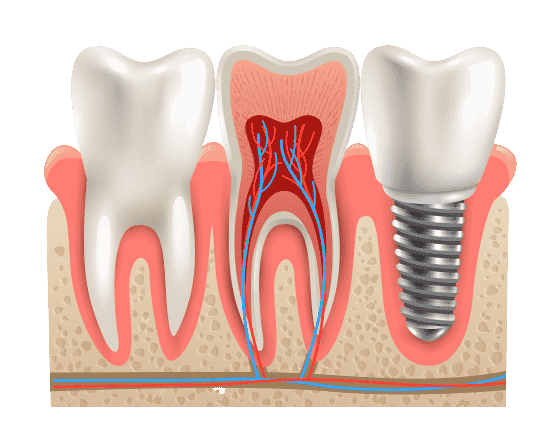 Reemplazo de piezas dentales